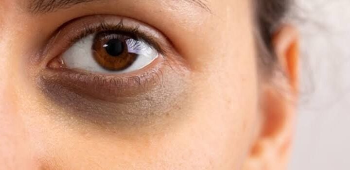 dark circles