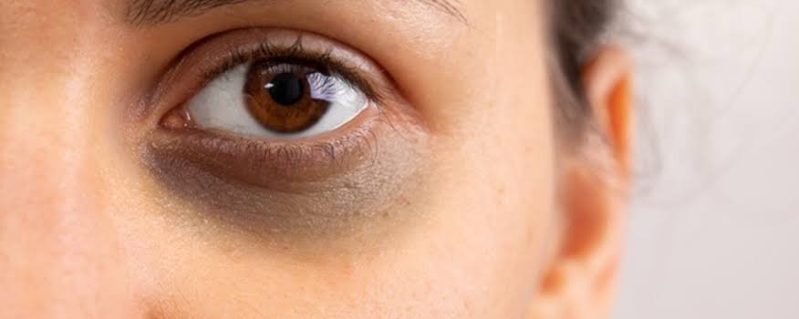 dark circles