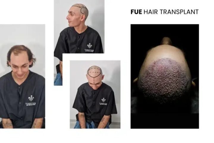  afro hair transplant