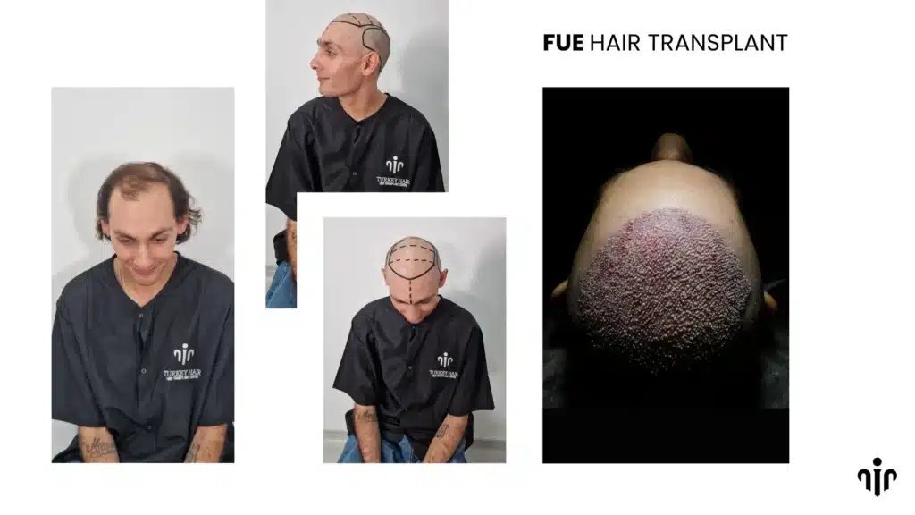 afro hair transplant